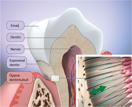 Ilningar i tänderna